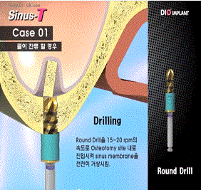 Sinus-T sinus lift technique for dental implants using DIO's specialist burrs and osteotome kit - No Sound